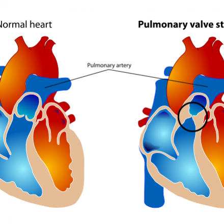 London Paediatric Cardiologist | Child Heart Specialist