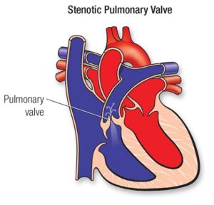 Pulmonary Valve Stenosis: symptoms, causes and diagnosis