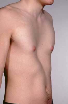 mild concave chest
