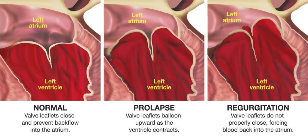 Mitral Valve Prolapse Child Heart Specialist Paediatric Cardiologist